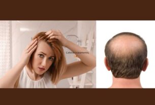 Calvície tratamento